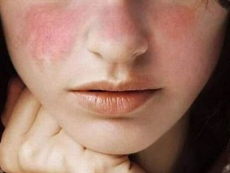 En el D&iacute;a Mundial del Lupus municipio llama a la comunidad a informarse sobre esta enfermedad y generar conciencia social